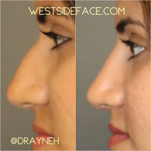 Female Septoplasty Westside Face