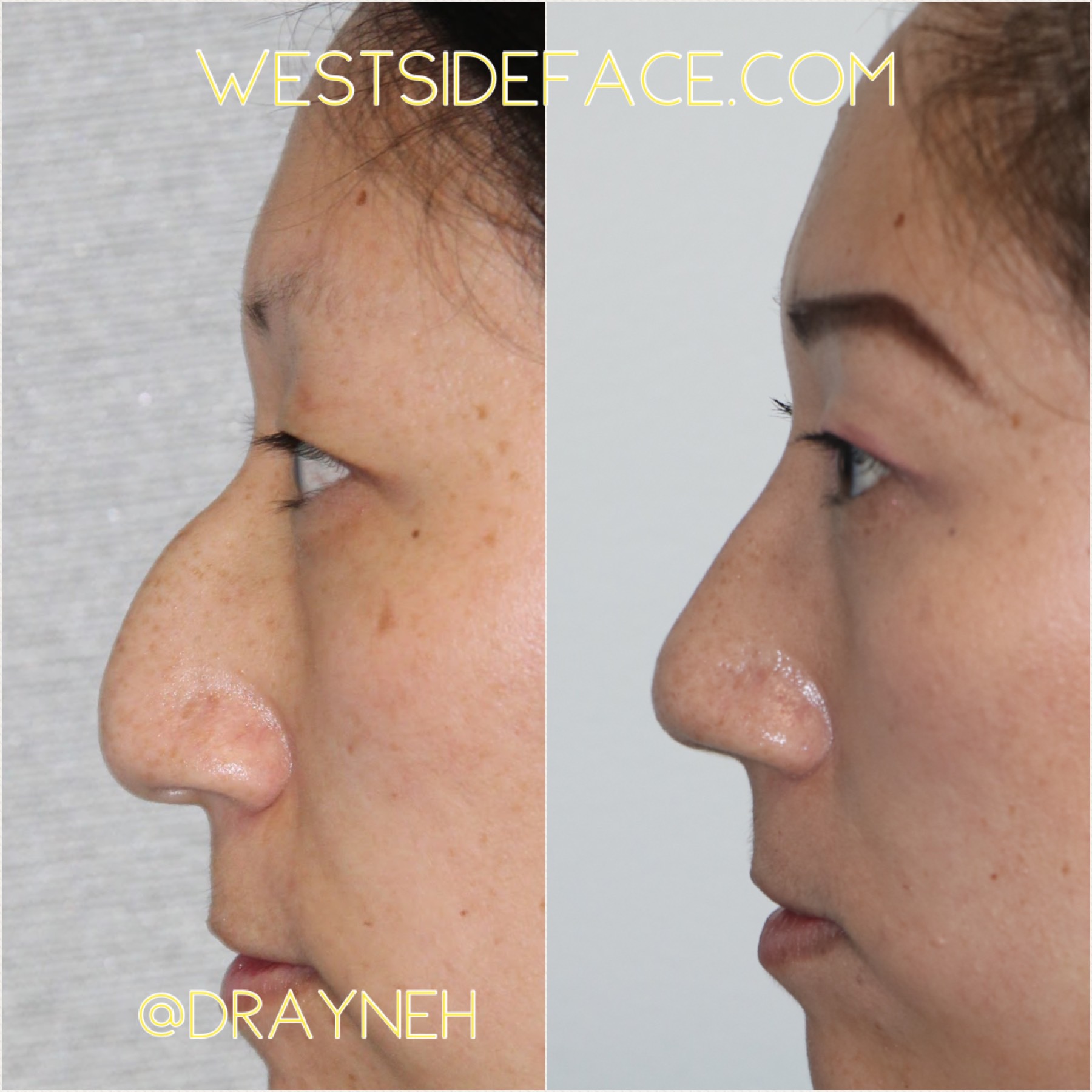 Closed Scarless Ethnic Rhinoplasty And Crooked Nose Repair Westside Face