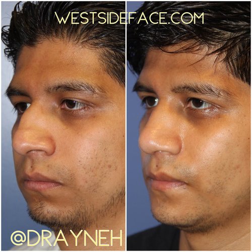 Crooked Nose Repair - Westside Face