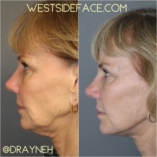 Revision Facelift female - Westside Face