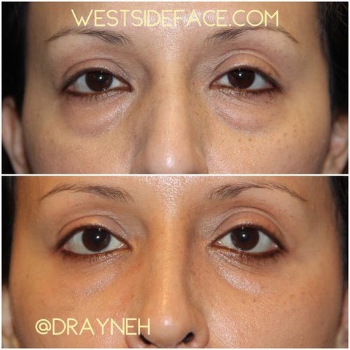 Eyelid Lift - Westside Face