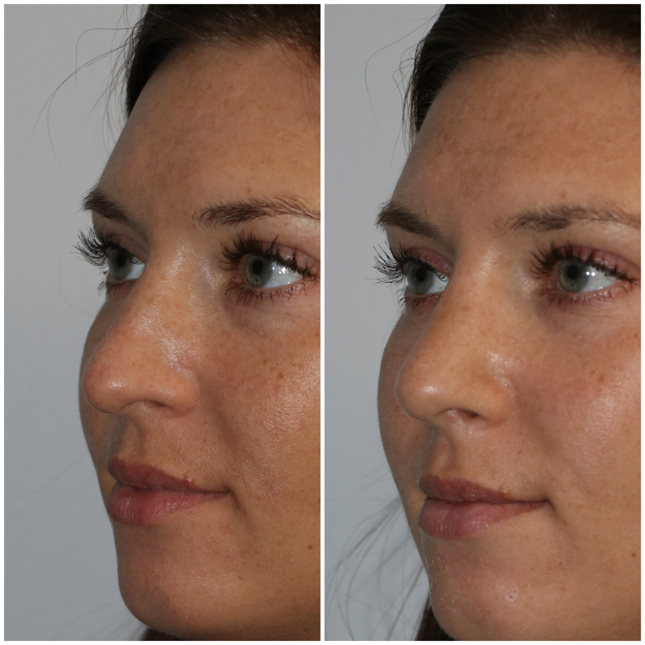 Closed Scarless Rhinoplasty - Westside Face