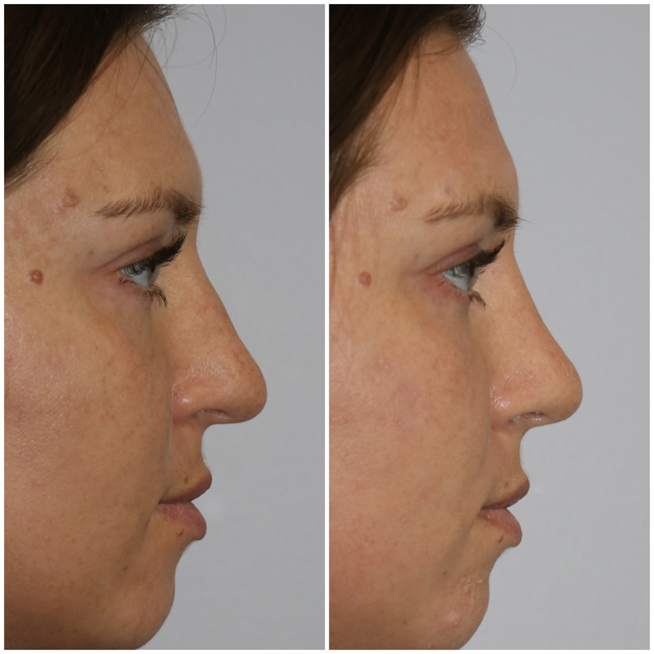 Female rhinoplasty