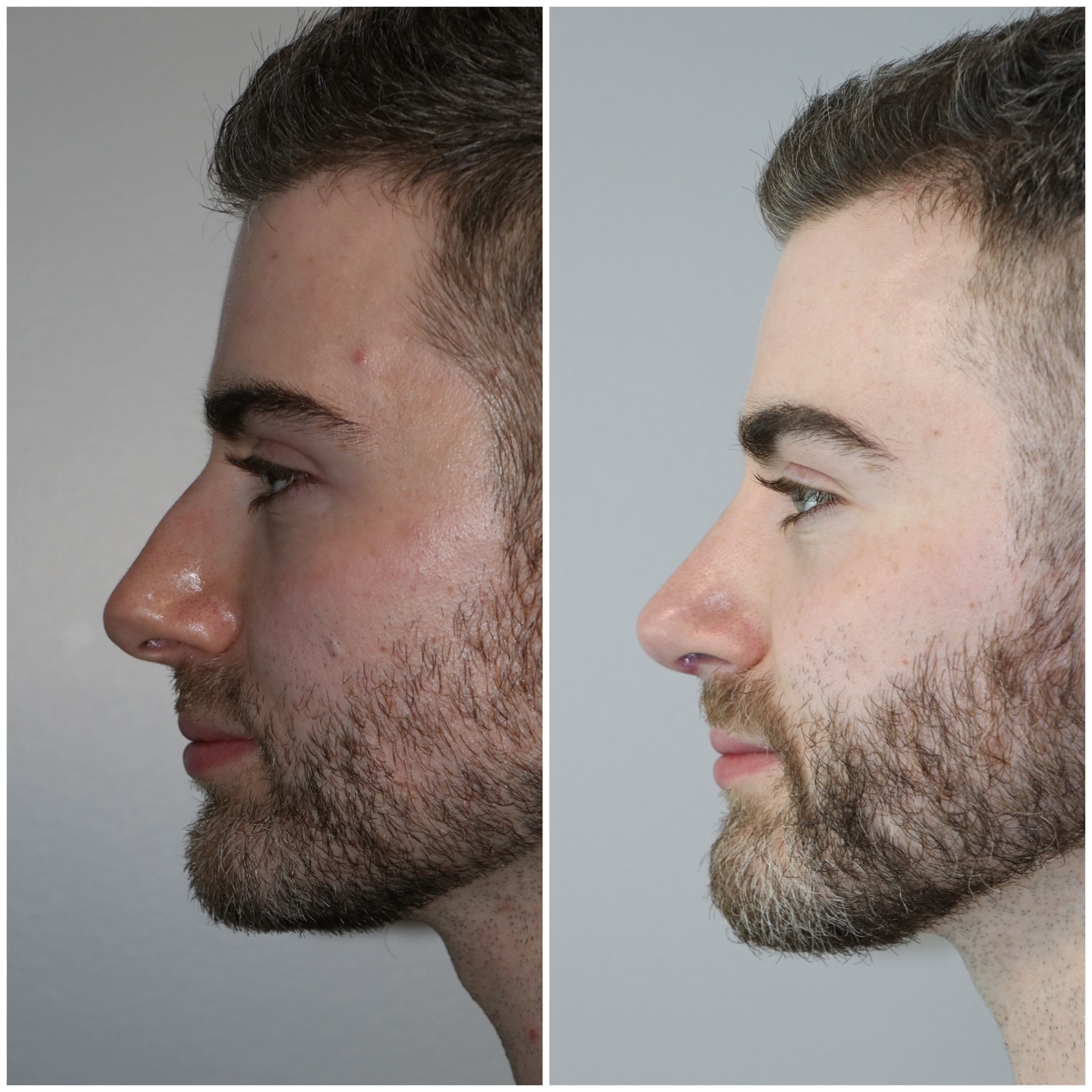 Crooked Nose Repair - Westside Face