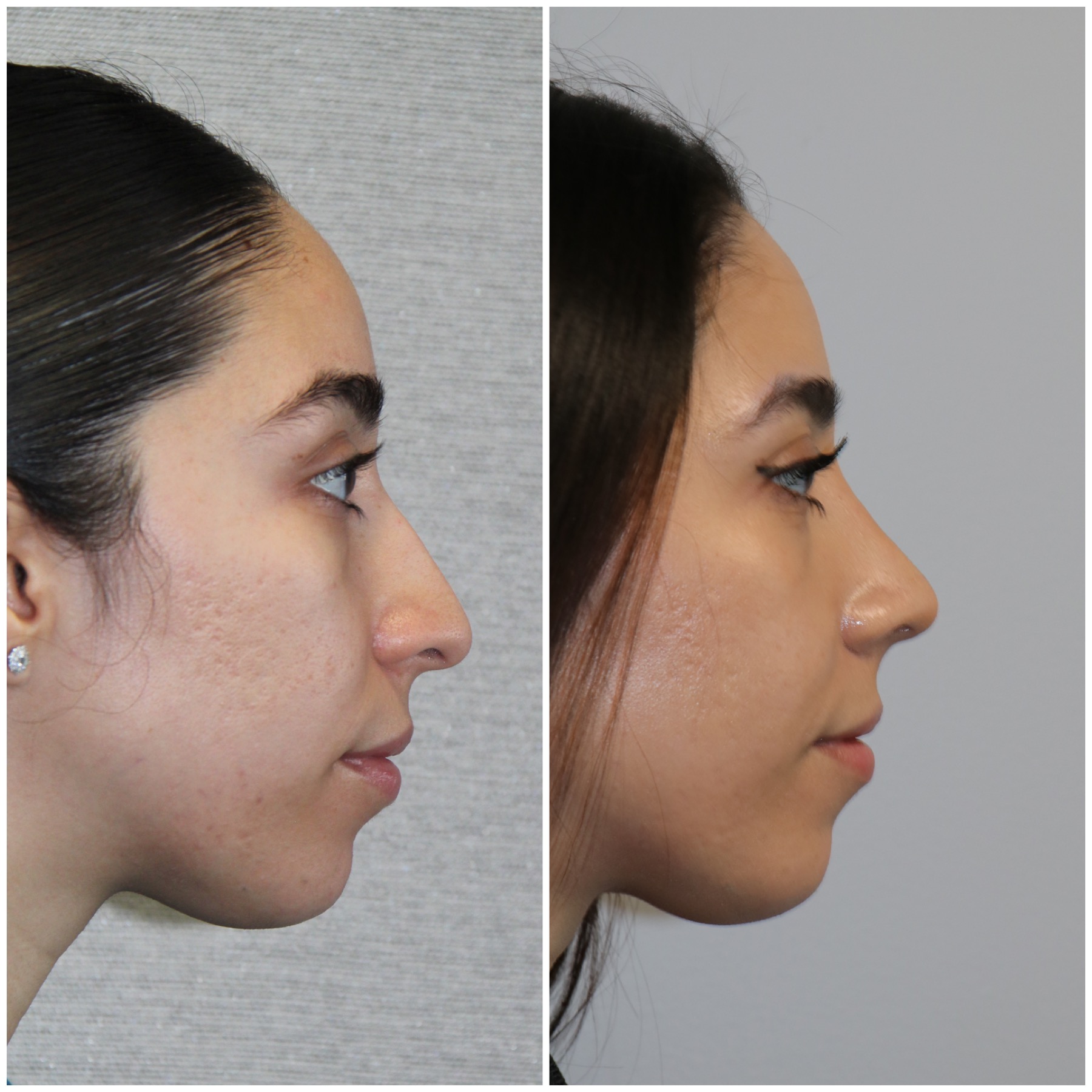 Closed Scarless Rhinoplasty Westside Face