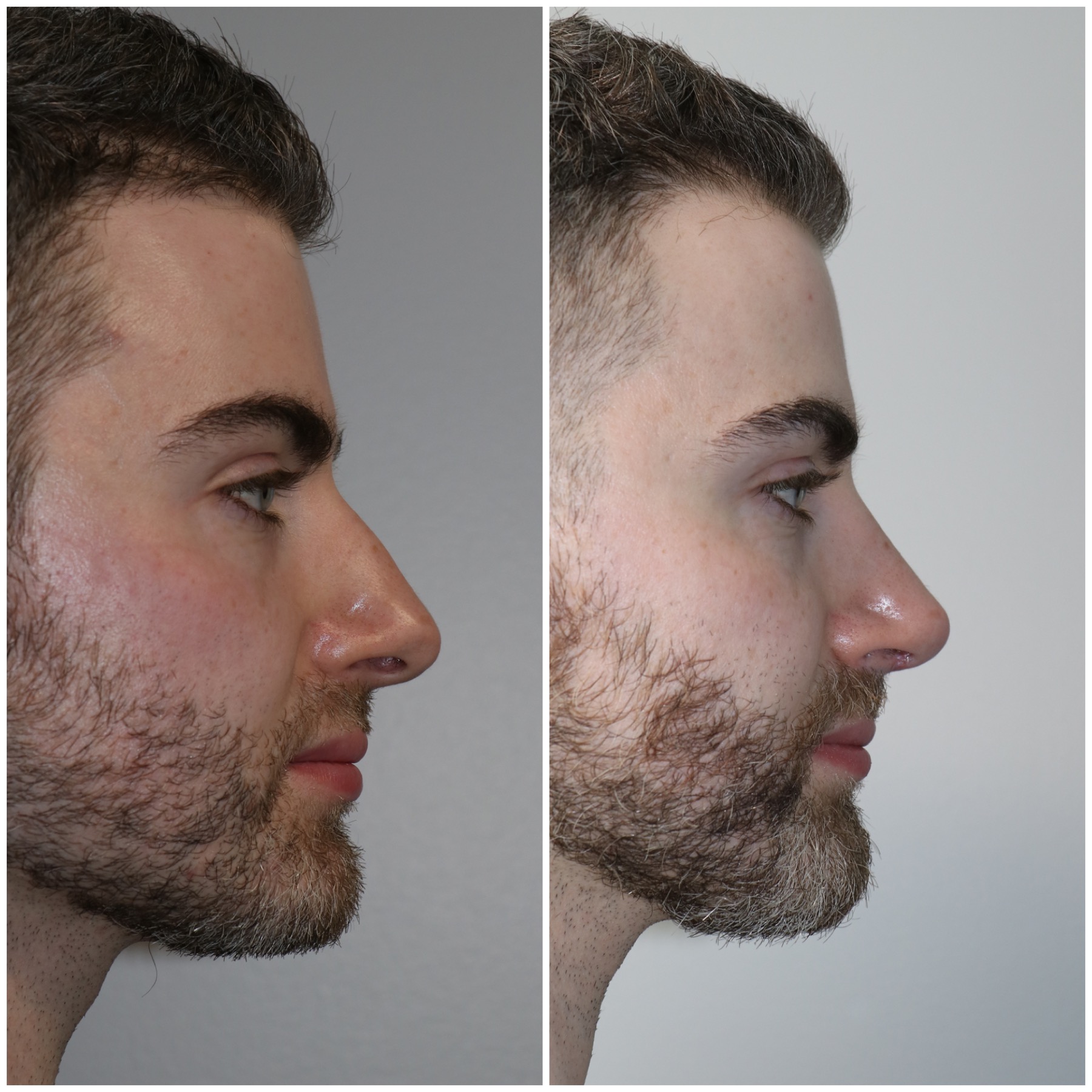 Crooked Nose Repair - Westside Face