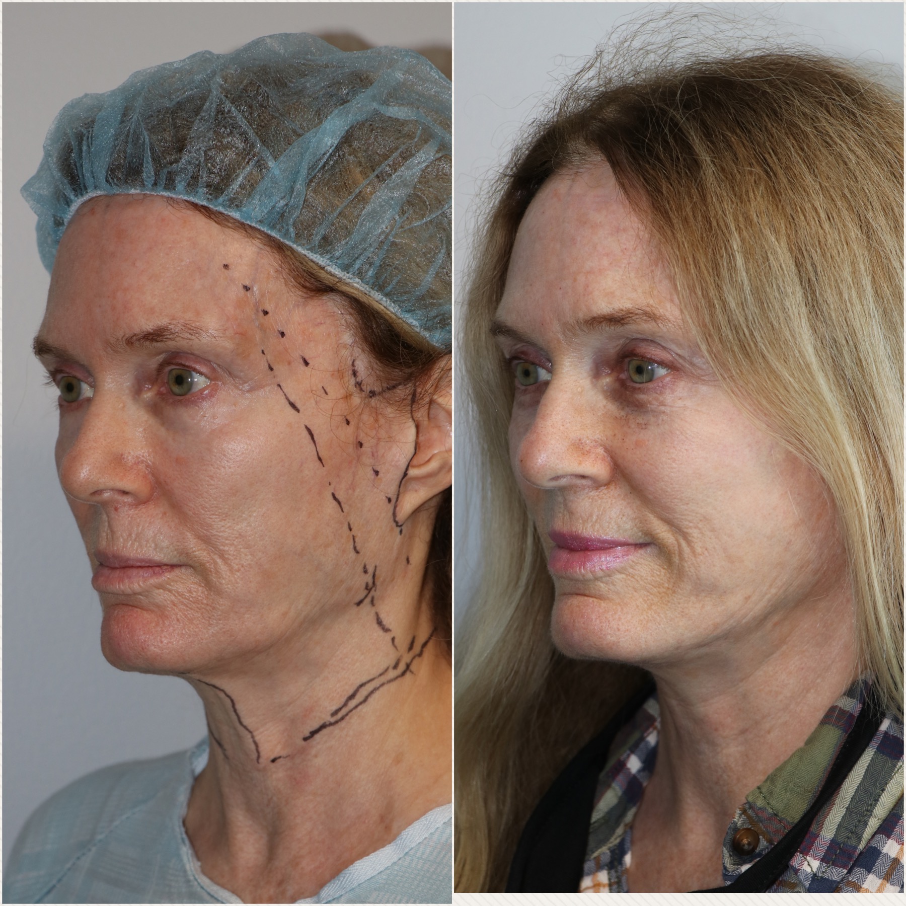 Revision Facelift Female Westside Face