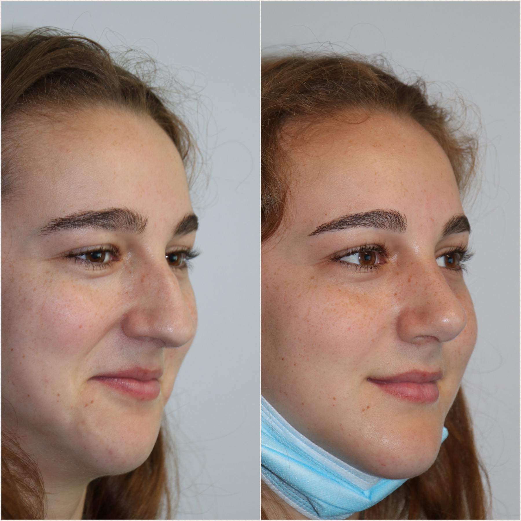 Female Rhinoplasty Westside Face