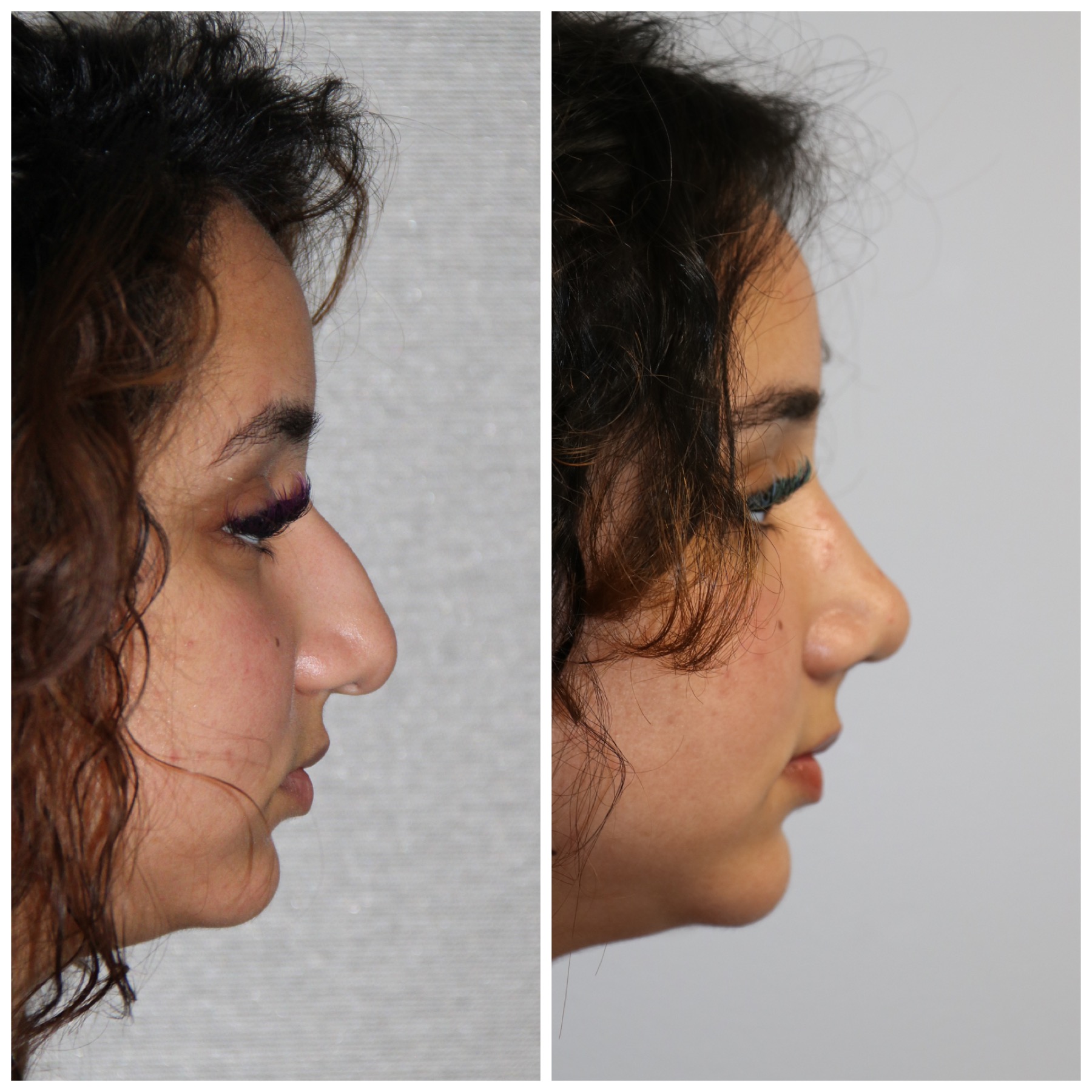 Middle Eastern Rhinoplasty Westside Face