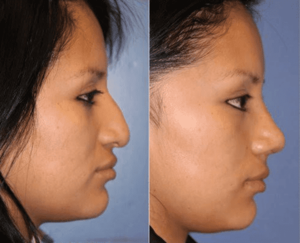 Los Angeles Facial Plastic Surgery - Delivering Natural-Looking Results