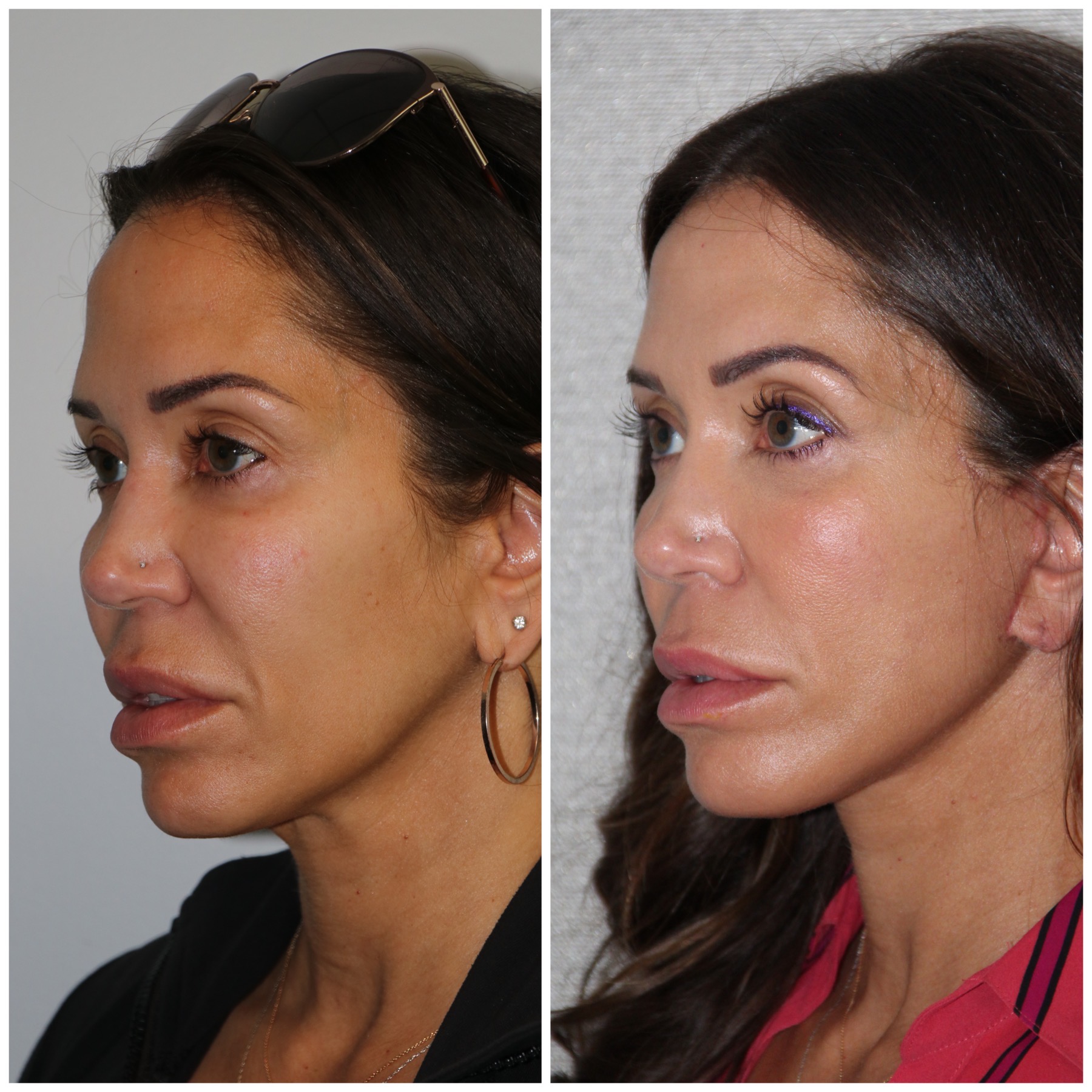 Female Facelift - Westside Face